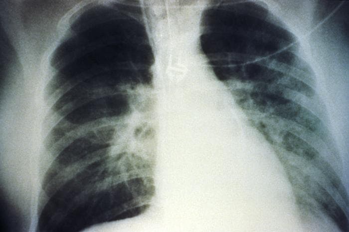 Radiografie toracica dintr-un caz de sindrom pulmonar cu hantavirus, cu afectare respiratorie severa.
